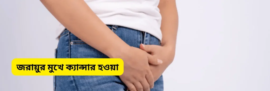 জরায়ুর মুখে ক্যান্সার হওয়া