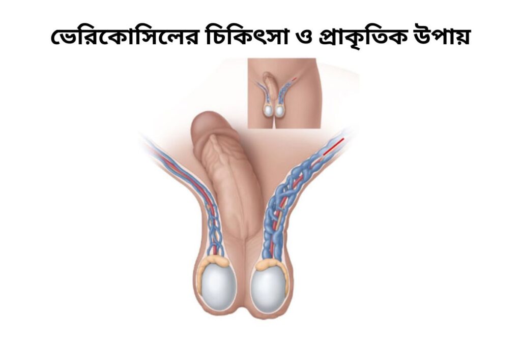 ভেরিকোসিল কী, কেন হয়, চিকিৎসা, ব্যায়াম ও সন্তান জন্মের ঝুঁকি 1 পুরুষের অণ্ডকোষে ভেরিকোসিলের অবস্থান চিত্র
