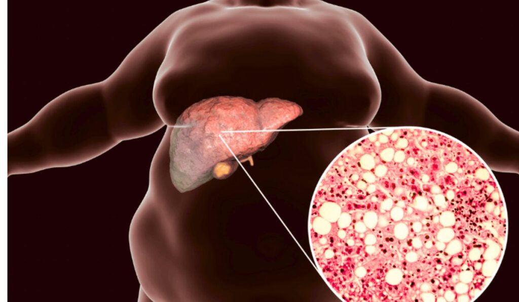 ফ্যাটি লিভার গ্রেড 3