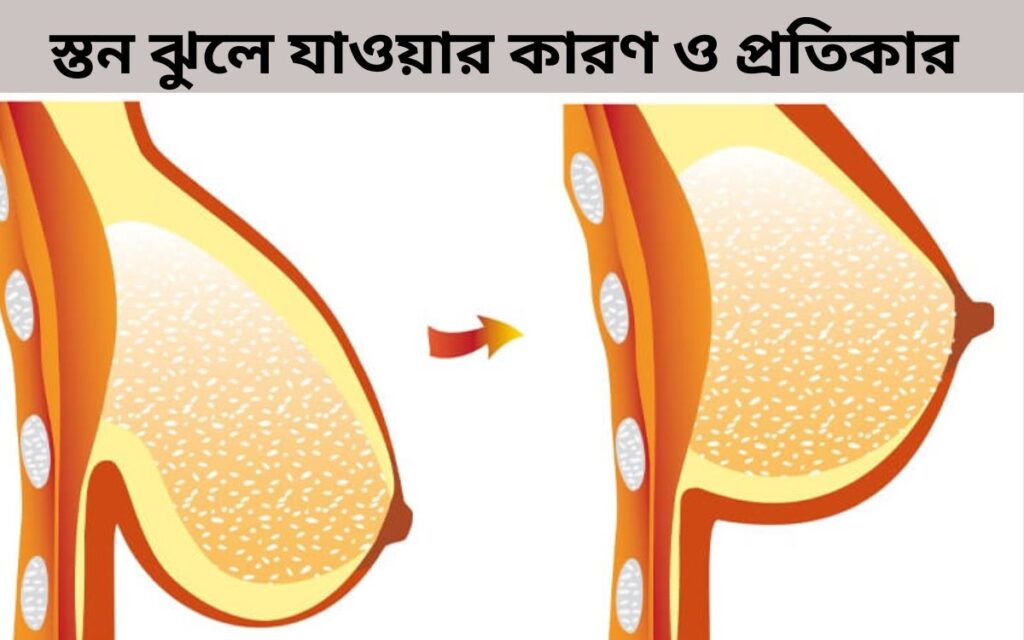 স্তন ঝুলে যাওয়ার কারণ