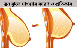 স্তন ঝুলে যাওয়ার কারণ