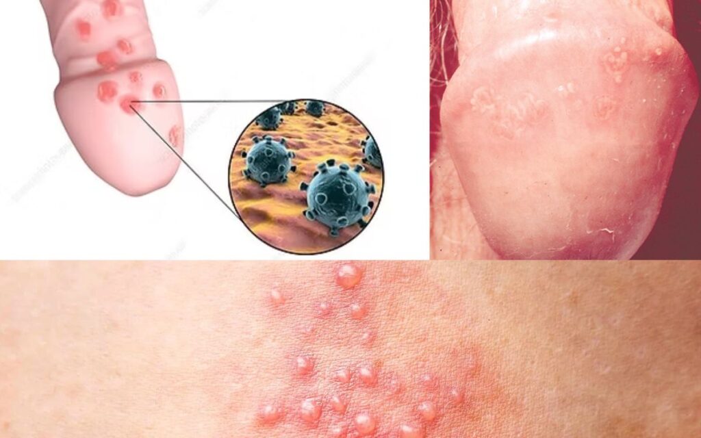 যৌনাঙ্গ হারপিস: কারণ, লক্ষণ, চিকিৎসা ও প্রতিরোধ 1 জেনিটাল হার্পিস