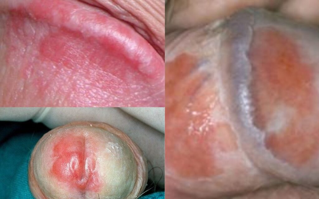 ব্যালানাইটিস