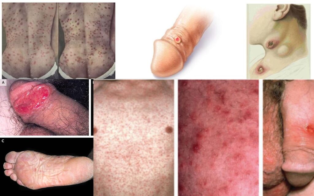 সিফিলিস