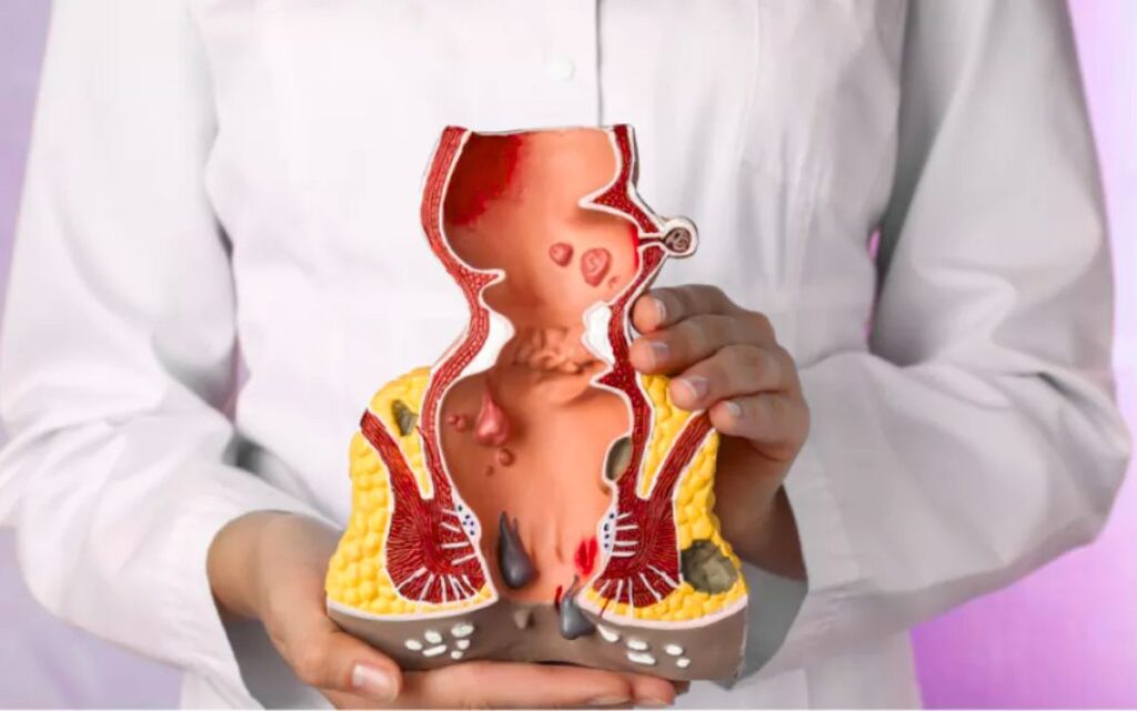 পাইলস থেকে ক্যান্সার এর লক্ষণ