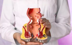 পাইলস থেকে ক্যান্সার এর লক্ষণ