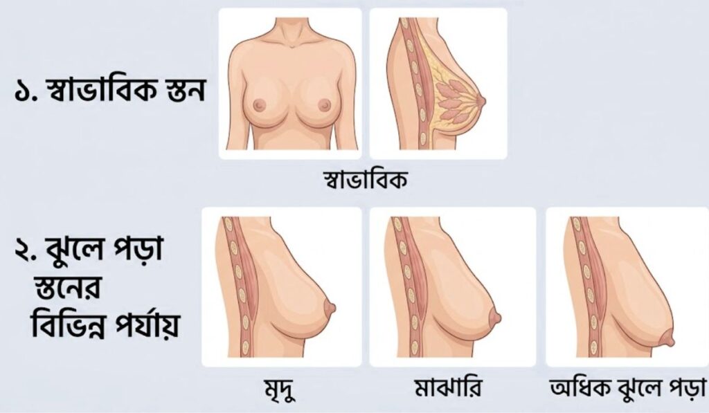 ঝুলে যাওয়া স্তন